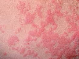 Image result for skin rash similar to scabies