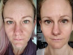 Monat skincare results after 2 years