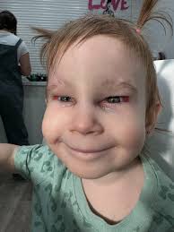 Visually Impaired Toddler's Life-Changing Eye Surgery Journey