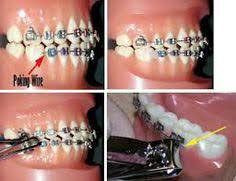 Begin by breaking off a tiny piece of wax from the pack provided to you. 9 How To Use Orthodontic Wax Ideas Orthodontics Wax Braces Tips