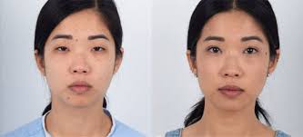 Plastic Surgery in Los Angeles