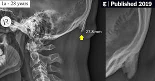 Bone also plays important roles in maintaining mineral homeostasis, as well as providing the environment for hematopoesis in marrow. About The Idea That You Re Growing Horns From Looking Down At Your Phone The New York Times