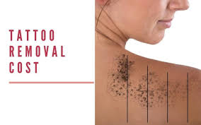 Laser tattoo removal cost although the amount that it will cost to remove your tattoo will vary from person to person, you can generally expect to pay roughly $200 to $500 per treatment. Tattoo Removal Cost In Delhi Desmoderm
