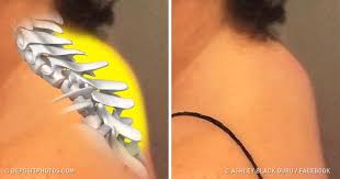 What Is Dowager S Hump And How To Fix It It S Not Only About Your Posture Health Knowledge Herbal Remedies Remedies