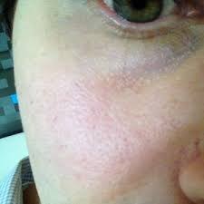 Using these methods, you should be able to improve your overall appearance. How Can I Improve The Texture Of Orange Peel Skin With Rosacea Photo