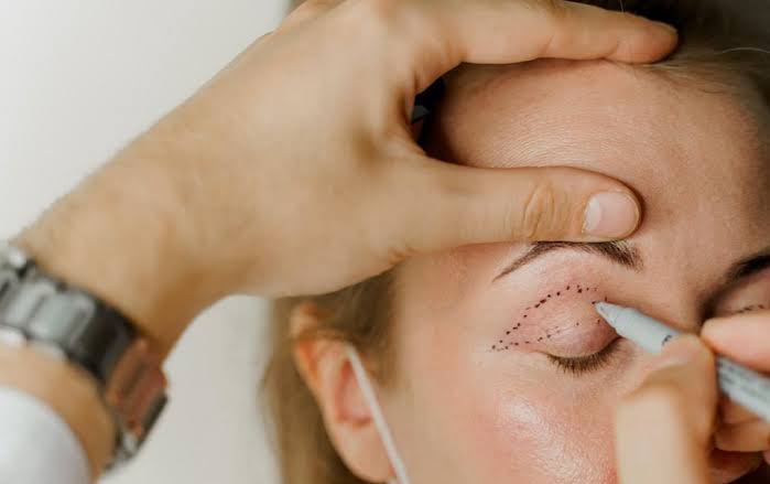 Eyelid Surgery in Islamabad - Blepharoplasty