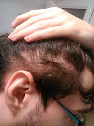Her sisters both have full heads of very fine hair, but tons of it. How Bad Is My Diffuse Hairloss Getting Hairlosstalk Forums