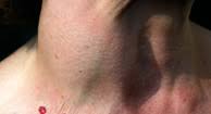 Throat cancer is a type of head and neck cancer. Thyroid Cancer Types Risk Factors And Symptoms