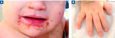 Le responsable de cette maladie est un virus. Symptomatologie Et Evolution De La Maladie Pieds Mains Bouche Sciencedirect