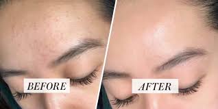 Learn more information at patient. Redditor Shares Transformative Fungal Acne Routine See Her Before After Photos Allure