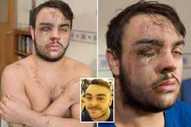 Horrified reveller Steven Hose tells how the skin