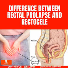 Image result for Rectal prolapse