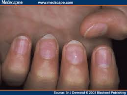 Image result for Mees Line