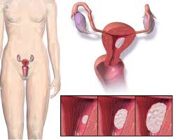 Algunos sarcomas uterinos se diagnostican durante o después de la cirugía y muchas veces la mayoría, sin embargo, se diagnostican debido a los síntomas. Cancer De Utero Que Es Sintomas Causas Prevencion Y Tratamiento Top Doctors