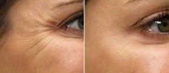Lo uso desde los 29 años. Tratamiento Arrugas Cara Botox New Metica Clinica De Medicina Estetica
