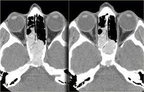 Image result for Sinus CT