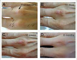 Warts are the cutaneous manifestations of human papilloma virus (hpv) that may exist in different the use of oral acitretin in the treatment of recalcitrant warts is under studied in literature where. Topical Vitamin A Treatment Of Recalcitrant Common Warts Semantic Scholar