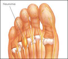 Morton S Neuroma What Is It And How To Stop The Pain Dallas Tx Foot Doctor