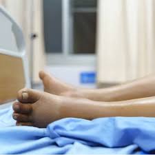 Image result for Edema Exam