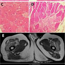 Muscle fatigue has also been shown to play a role in acute muscle injury.1 clinically relevant anatomy the quadriceps femoris is a hip flexor and a knee extensor. Muscle Histopathology And Mri Of Upper Thigh Axial Sections A D Download Scientific Diagram