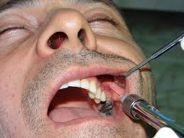 Overview Of Local Anesthesia Techniques Intechopen