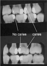 Examples Of Bitewing Images Demonstrate Either Secondary Caries Present Download Scientific Diagram