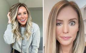 En raros casos, este efecto puede extenderse a otros músculos cerca de la zona. Cuando El Botox Sale Mal Influencer Se Inyecta Y Se Le Cae El Parpado