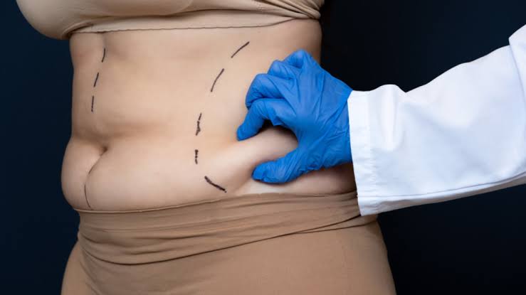 Liposuction Procedure Steps in Turkey: Recovery Timeline! - İrmet Hospital