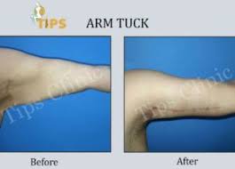 Brachioplasty Arm Tuck In 2020 Best Plastic Surgeons Cosmetic Surgery Arm Lift Surgery