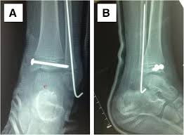 This bone is part of the fibula, one of two bones of the lower leg. Cannulated Screw And Kirschner Fixation For The Treatment Of Medial And Lateral Malleolar Epiphyseal Fractures In Children A Retrospective Study Of 36 Cases Journal Of Orthopaedic Surgery And Research Full Text