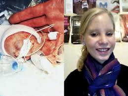 Once tiniest premature babies beat odds, grow up healthy