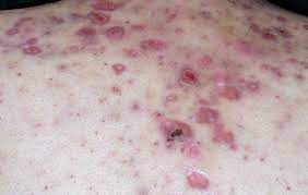 Nodules are inflammatory lesions with a diameter of 5 mm or greater. Nodular Acne Treatment And Home Remedies