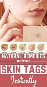 Natural Remedies To Remove Skin Tags Fast In 2020 Skin Tag Removal Mole Removal Cream Skin Moles