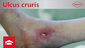 Ulcus Cruris Mixtum Wundbehandlung Offenes Bein Draco