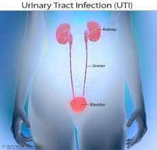 Tests and procedures used to diagnose urinary tract infections include: Urinary Tract Infection Uti Symptoms Treatment Home Remedies Prevention