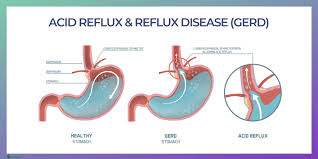 Gerd can affect people of any age group or sex, but it is more prevalent among older individuals. Gastroesophageal Reflux Disease Gerd Symptoms Causes Natural Home Remedies And Reflux Diet Ecosh Life