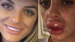 Elegir un centro médico autorizado. Fiesta De Botox El Trauma De Una Mujer Que Termino En El Hospital Por La Hinchazon De Sus Labios Bbc News Mundo