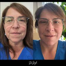 𝑫𝒆𝒆𝒑 𝑷𝒍𝒂𝒏𝒆 𝑵𝒆𝒄𝒌 𝑳𝒊𝒇𝒕: 𝑻𝒉𝒆 𝑮𝒐𝒍𝒅 𝑺𝒕𝒂𝒏𝒅𝒂𝒓𝒅  𝒇𝒐𝒓 𝑵𝒆𝒄𝒌 𝑹𝒆𝒋𝒖𝒗𝒆𝒏𝒂𝒕𝒊𝒐𝒏 & 𝑪𝒐𝒏𝒕𝒐𝒖𝒓𝒊𝒏𝒈 Unlike neck  liposuction which can provide surface-level fat removal yielding subtle  improvements, the deep plane ...