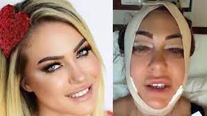 Yeliz yeşilmen'in aldatıldığı iddiası magazin gündemine bomba gibi düştü. Yeliz Yesilmen De Estetik Operasyon Aciklamasi Hem Para Veriyorsunuz Hem Aci Cekiyorsunuz
