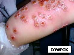 Image result for vaksinasi cacar cowpox