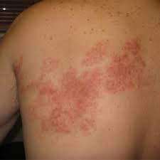 Symptoms typically start with pain along the affected. Post Herpes Zoster Pain Treatment In Delhi Orlin Clinic
