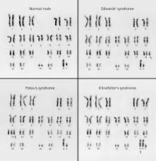 A Karyotype Is The Number And Appearance Of An Organism S Chromosomes These Karyotypes Compare A Norrmal Male Genetic Disorders Genetics Klinefelter Syndrome