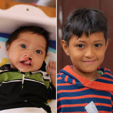 Fatima has been part of our program since her birth! Throughout the years,  she has participated in our milk program, undergone multiple surgeries,  received dental treatment, and is currently enrolled in our