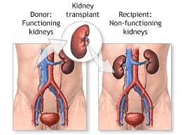 Image result for Transplantation
