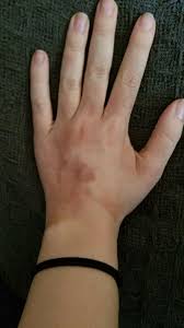 Orange brown spots on hands. Skin Concerns The Dark Spots Appeared Overnight I M Only 24 It Doesn T Burn Or Feel Any Different Than My Normal Skin Any Help Would Be Appreciated Skincareaddiction