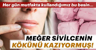 Sivilcenin Kokunu Kaziyor Sifali Tarifler Kuru Cilt Cilt Bakimi Tuyolari Cilt Bakimi