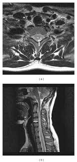 Consult a doctor for medical advice. Can Vaccines Cause Transverse Myelitis Vaxopedia