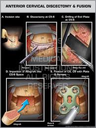 Anterior Cervical Discectomy Fusion Female Print Quality Instant Download Cervical Spine Surgery Medical Illustration