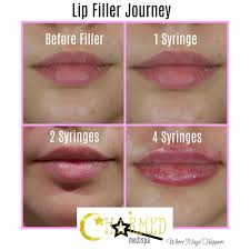For deeper folds or more vol. One Two Or Four Syringes Filler Lip Results Charmed Medispa
