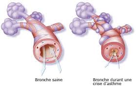 Ce médicament, sous forme de suspension pour inhalation buccale, s'administre par voie si un besoin de plus de doses de ventoline que d'habitude se fait sentir, sachez que ceci pourrait traduire une déstabilisation de la maladie asthmatique. L Asthme